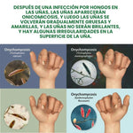 Protege y elimina el hongo de tus Uñas