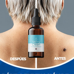 Elimina Verrugas con Verryclean+Envio Gratis